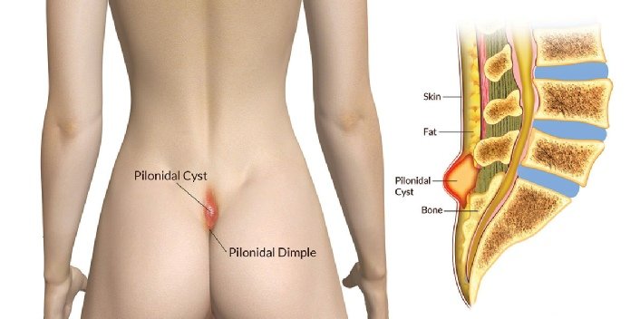 Laparoscopic Surgery for Gallbladder